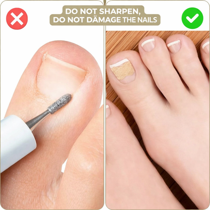Toenail Corrector Patches Ingrown Nail